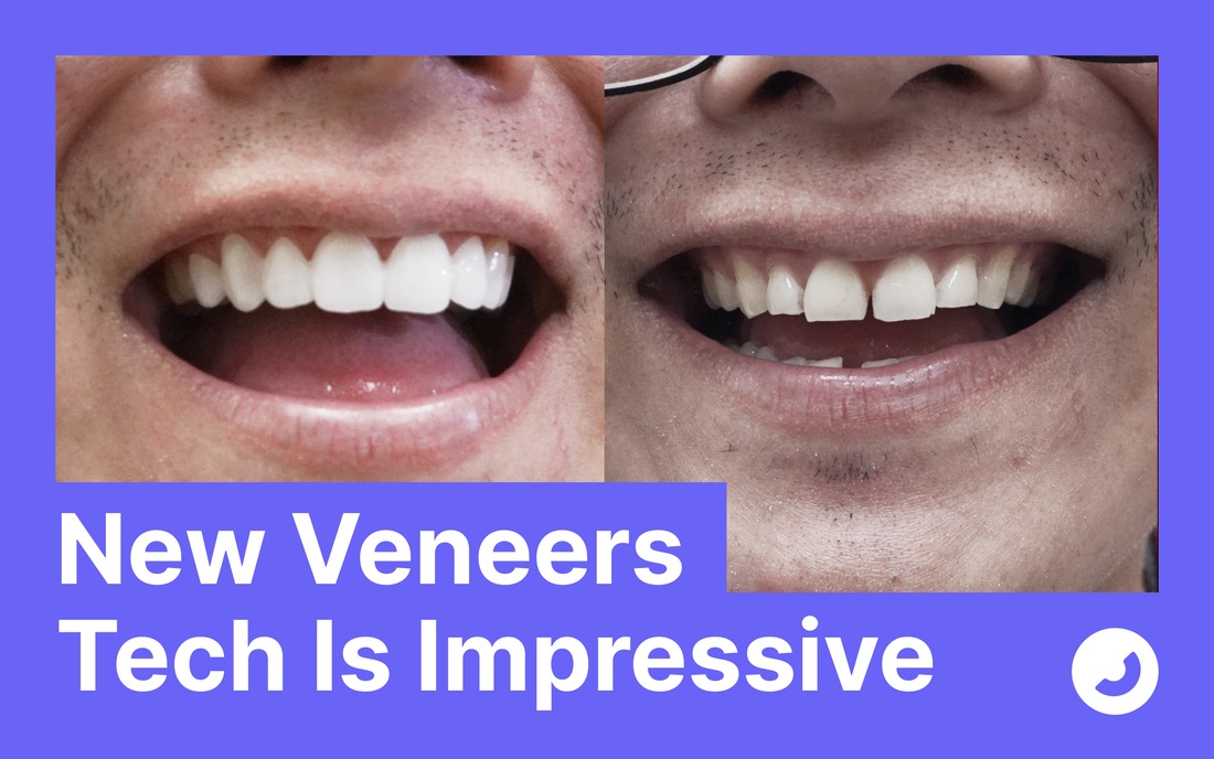 New Snap-On Veneer Technology Makes Dentures Obsolete